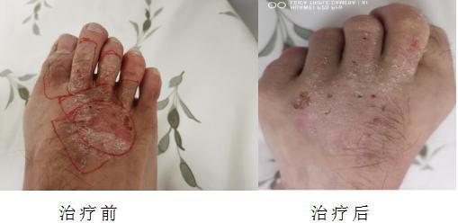 貼在身上的血管瘤治療利器 鍶 90敷貼器