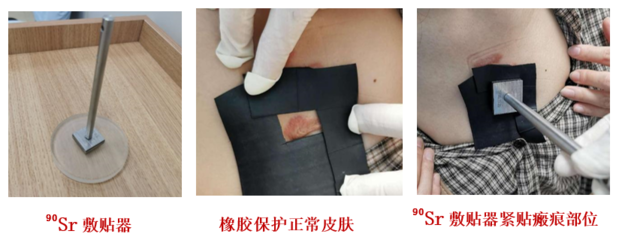 瘢痕疙瘩又丑、又癢、又痛怎么辦?它的&ldquo;克星&rdquo;來了